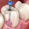 Do Prosthodontists Do Root Canals?