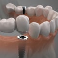 Can a Prosthodontist Restore Your Smile?