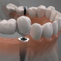 Can a prosthodontist remove teeth?