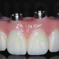How to Choose the Right Prosthodontist for Your Needs