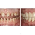 How Hard is it to Become a Prosthodontist?
