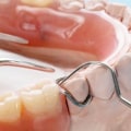 What are the different styles of dentures?