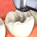 What professional does root canals?