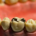 Does a prosthodontist do fillings?