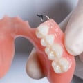 Are Flexible Dental Prostheses More Comfortable Than Other Dentures?