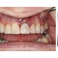 Can a Prosthodontist Do Tooth Extraction?