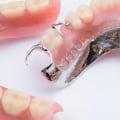 What are the newest type of dentures?