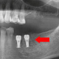 Do Prosthodontists Replace Missing Teeth?